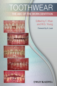 Toothwear: The ABC of the Worn Dentition