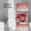 Bone Augmentation in Oral Implantology