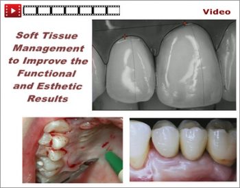 Soft Tissue Management To Improve The Functional And Esthetic Results