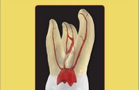 Ingle’s Endodontics, 7th Edition