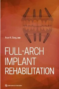 Full-Arch Implant Rehabilitation