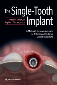 The Single-Tooth Implant