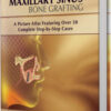 Maxillary Sinus Bone Grafting