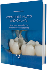 Composite Inlays and Onlays: Structural, Periodontal, and Endodontic Aspects