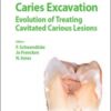 Caries Excavation: Evolution of Treating Cavitated Carious Lesions