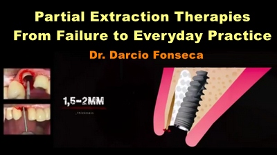 Partial Extraction Therapies From Failure to Everyday Practice