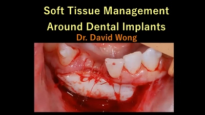 Soft Tissue Management Around Dental Implants