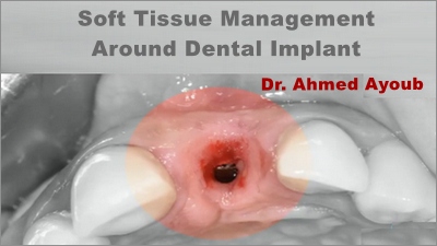 Soft Tissue Management Around Dental Implant, a Novel Approach