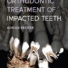 Orthodontic Treatment of Impacted Teeth, 4th Edition