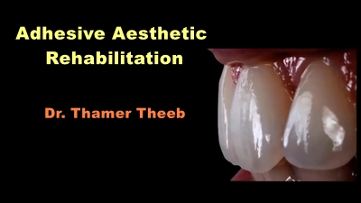 Adhesive Aesthetic Rehabilitation