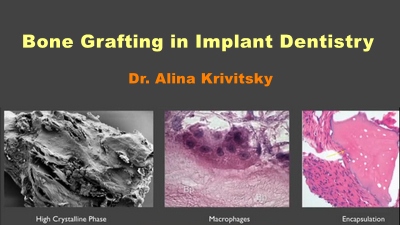 Bone Grafting in Implant Dentistry