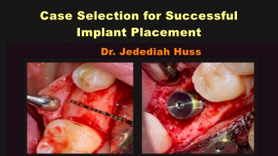 Case Selection for Successful Implant Placement