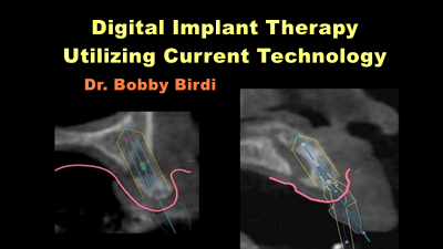 Digital Implant Therapy Utilizing Current Technology