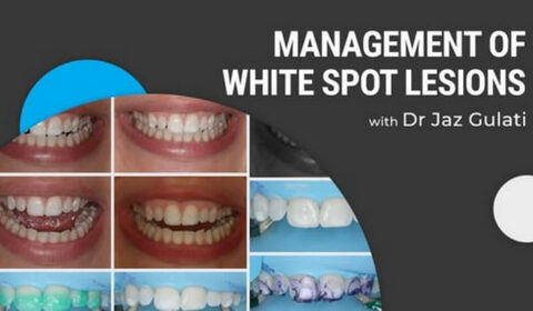 Management of White Spot Lesions