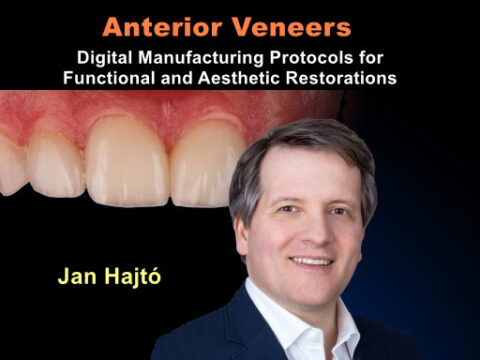 Anterior Veneers: Digital Manufacturing Protocols for Functional and Aesthetic Restorations