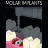 Immediate Molar Implants