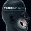 Tilted Implants: Implant-Prosthetic Rehabilitation of the Atrophic Patient
